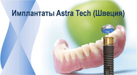 Astra Tech — технология лечения зубов в клинике Бондаревых