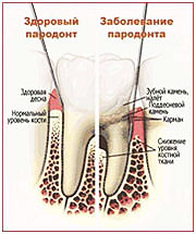 Парадонтит