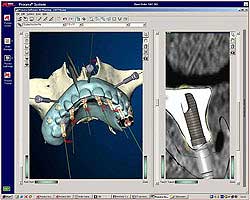 Имплантация Nobel Biocare