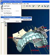 Имплантация зубов